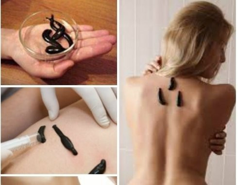 prodaza-medicinskoi-piiavki-big-1